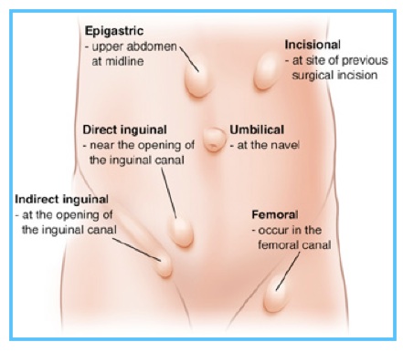 Hernias