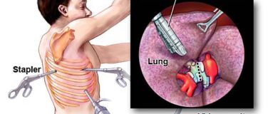 Advanced Minimally Invasive Pediatric Surgery